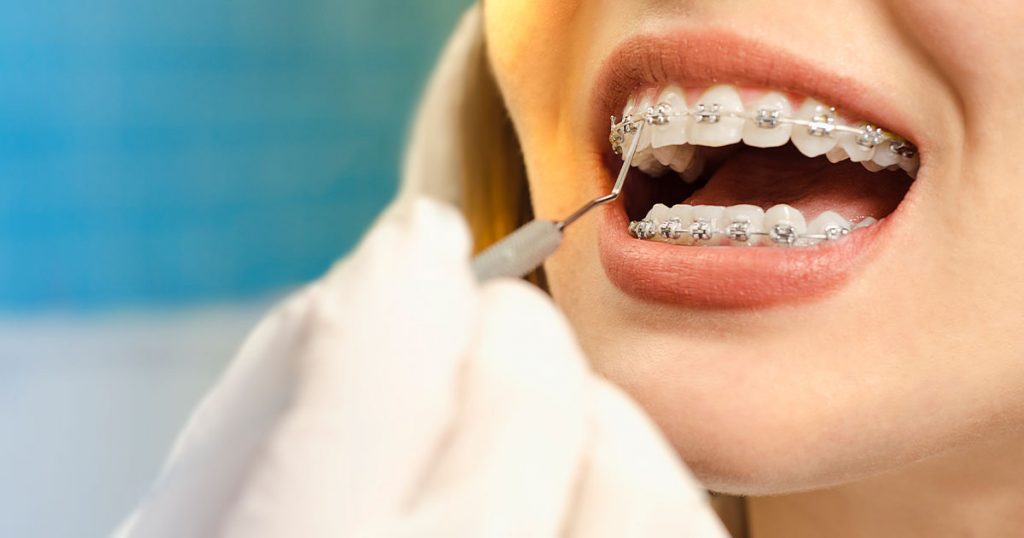 Tut Es Weh Wenn Die Zahnspange Rauskommt Muss ich auch zum Kieferorthopäden, wenn meine Zahnspange nicht weh tut